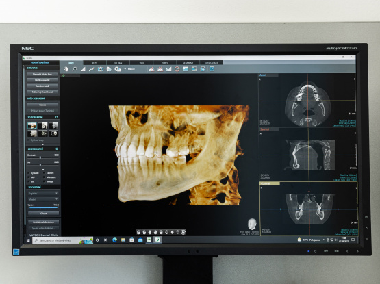 CBCT RTG přístroj Vatech Green 16